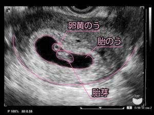 コロナ禍の妊活 妊娠おめでとう そして あまり知られていない大切な存在 卵黄嚢